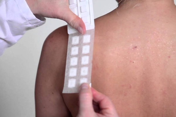 Che cos’è il patch test?